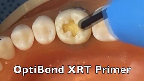 国产树脂补牙视频教程,轻松掌握补牙技巧  第2张