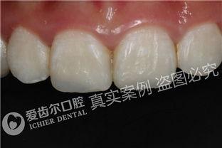 国产树脂补牙视频教程,轻松掌握补牙技巧  第3张